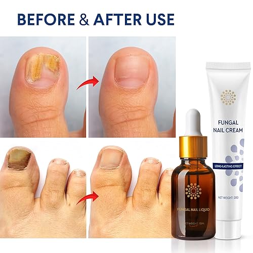 Miniatura 2 de Tratamiento de hongos en las uñas de los pies y las uñas líquido de tratamiento de uñas de hongos 15ML y crema reparadora de uñas antifúngica 20G -