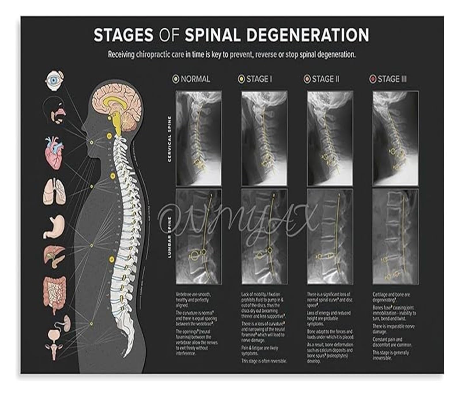 KCDFDVJFBM Anatomy Educational Poster Spinal Degeneration Level Chart Vertebral Subluxation Demonstration Canvas Print for Office Decor Gift(Framed,16x24inch(40x60cm))