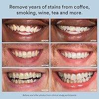 Vista 6 de Auraglow Tiras blanqueadoras de dientes, tiras blanqueadoras sensibles, 14 tratamientos de blanqueamiento, 8% de peróxido de hidrógeno