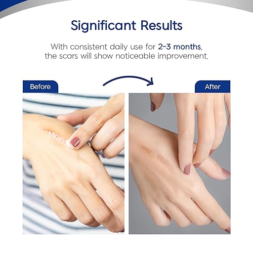 Miniatura 5 de MURASAKI BEAUTY Cinta y hojas de silicona para cicatrices  Eliminación de queloides, quemaduras, abrasión, cesárea y cicatrices quirúrgicas  Seguro