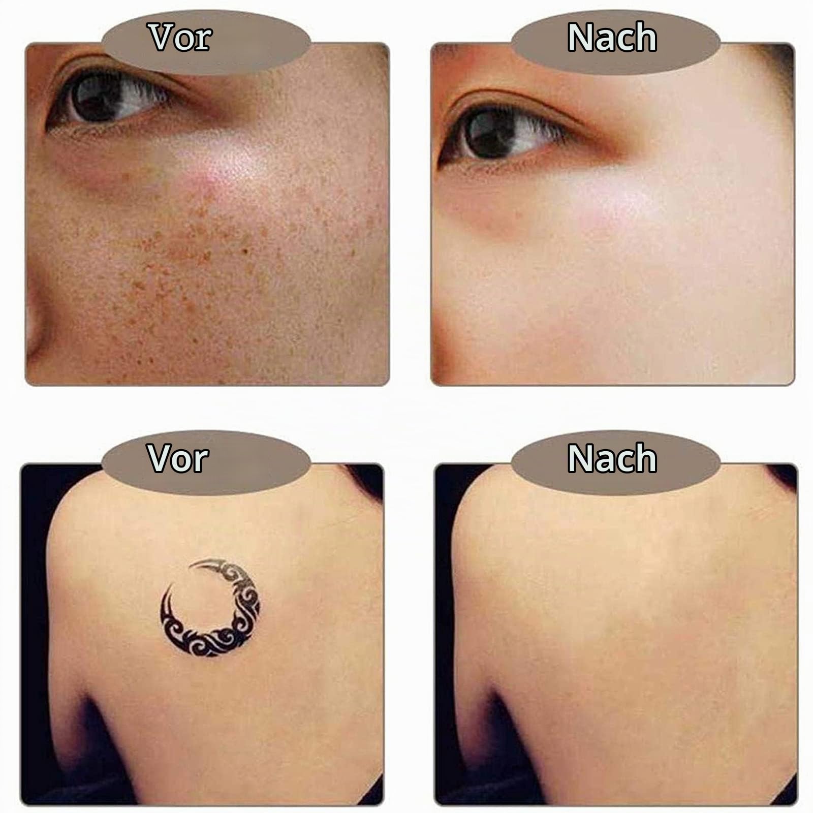 Picosecond Pen Freckle Tattoo Entfernung Mole Dark Spot Augenbrauen Pigment Laser Akne Behandlungs Maschine Beauty Care,Bluelight
