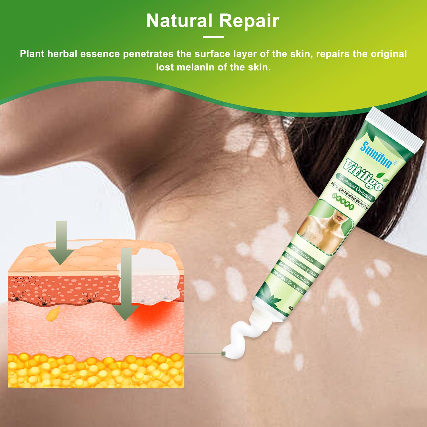 Buy Sumifun 8 Counts Vitiligo Cream Vitiligo Bleaching Cream for Skin