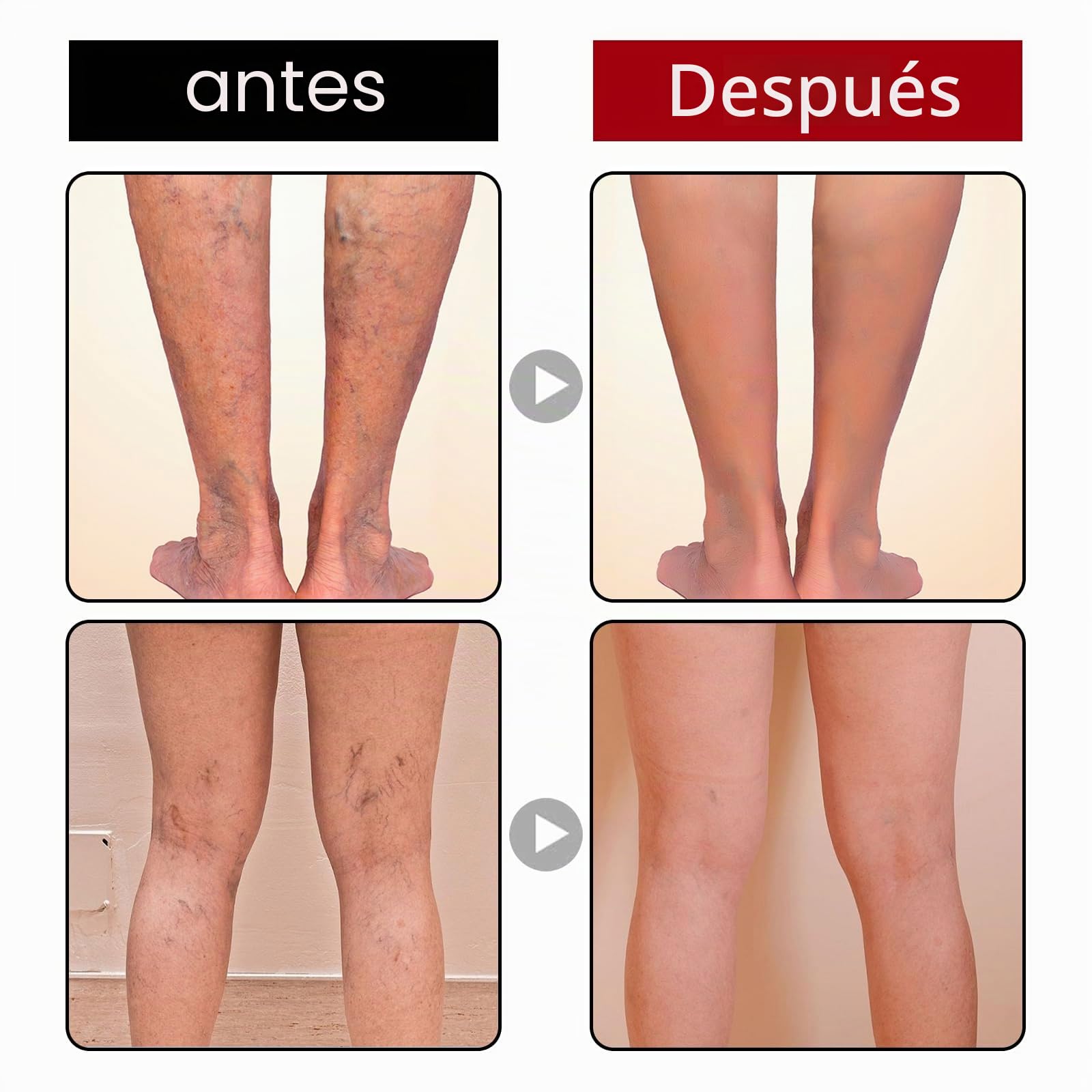 Crema Reparadora de Patas de Araña, Varicoso Vena Calmante Pierna Crema, Crema para Venas de araña para Uso Externo, Eliminación de Arañas para el Dolor de Piernas y Muslos