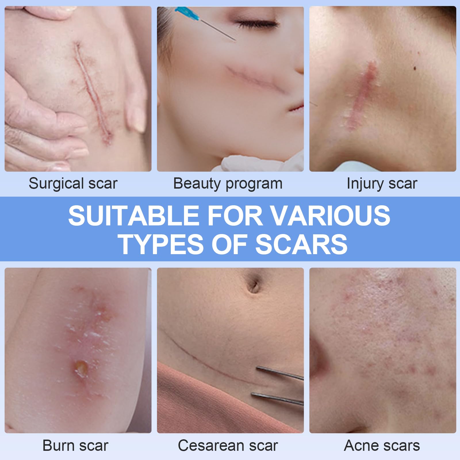 Silicone Scar Gel, 30g – Medical-Grade Scar Removal Gel For C-Section, Surgery, Acne, Stretch Marks & Burns – Fades Old & New Scars, Clinically Proven