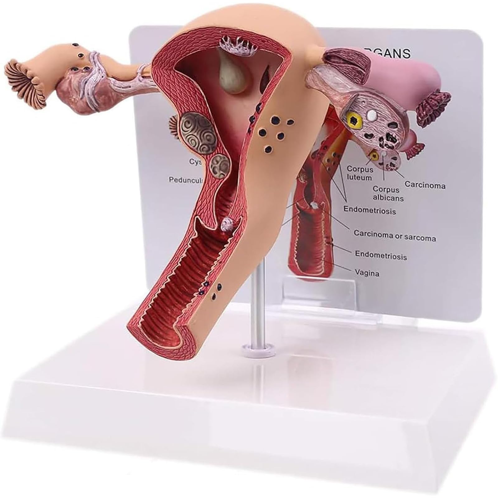 Adtzpc Female Uterus Ovary Model, Female Reproductive Organs Anatomy Model, Pathological Uterus and Ovary Anatomical Model, Life-Size Realistic for Doctor's Office and Classrooms