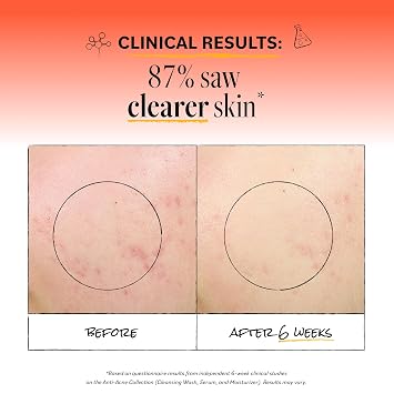 Derma E Acne Deep Pore Cleansing Wash Blemish Control Facial Cleanser with Salicylic Acid - Gentle Oil Control Face Wash Soothes and Balances Skin, 6 fl oz