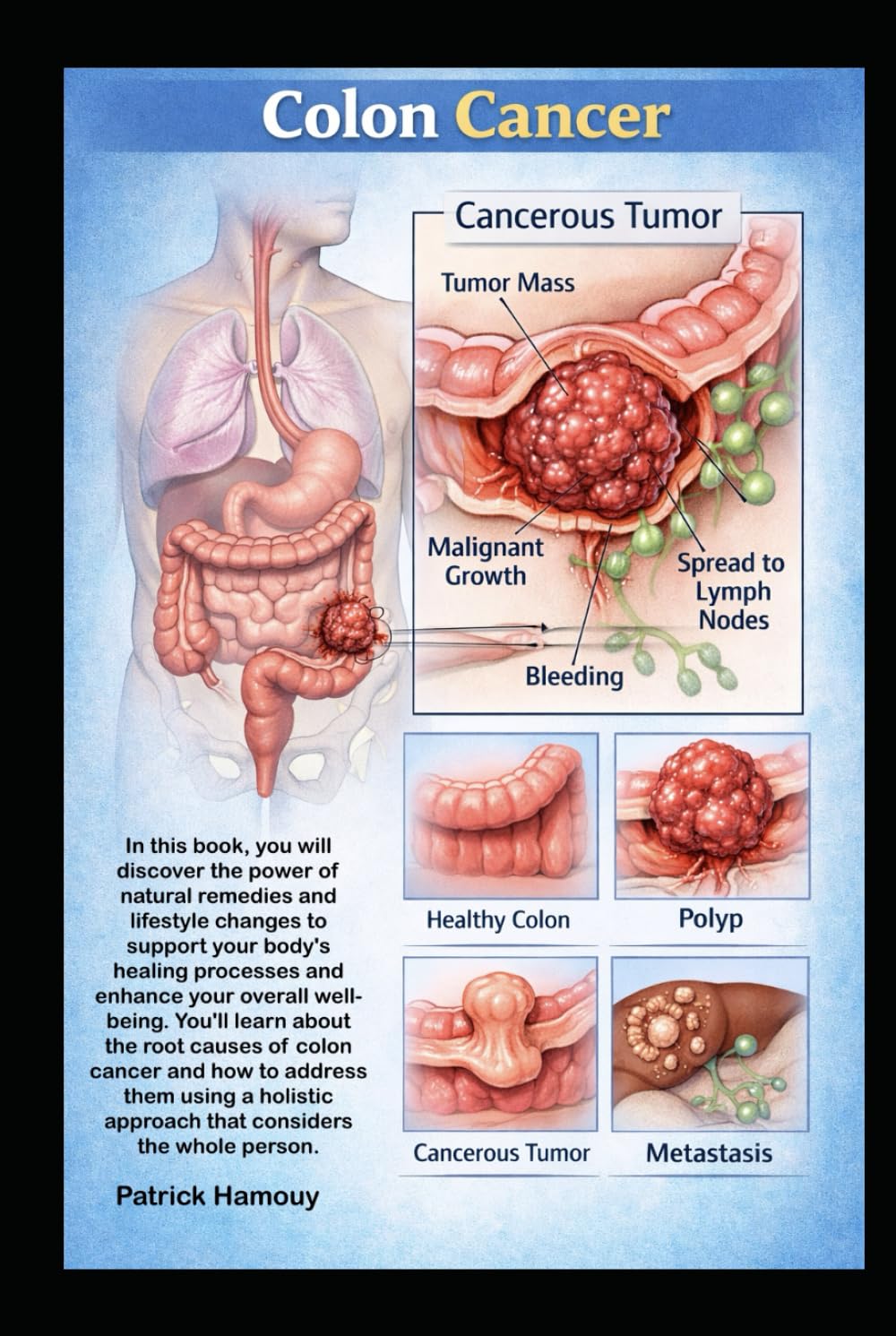 Colon Cancer Healed Naturally: Food, Herbs, Supplements and detox to beat Colon Cancer