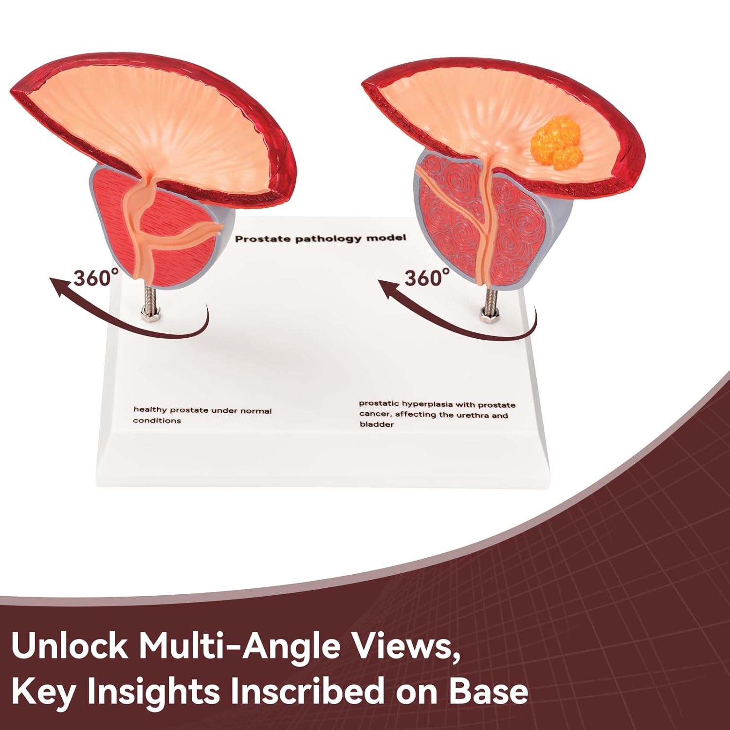 Prostate Pathological Anatomy Model - Male Urinary Reproductive System Model,Male Reproductive System Educational Model,Detachable 3D Prostate with BPH and Cancer for Medical Teaching