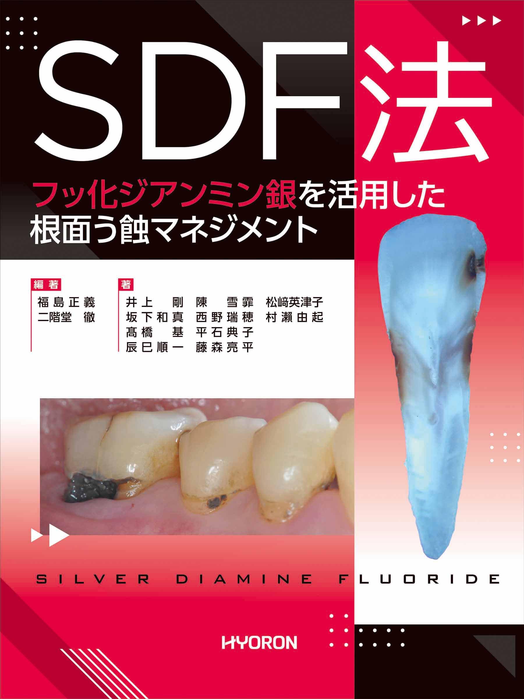 SDF法 : フッ化ジアンミン銀を活用した根面う蝕マネジメント Amazon.co.jp: SDF法―フッ化ジアンミン銀を活用した根面う蝕