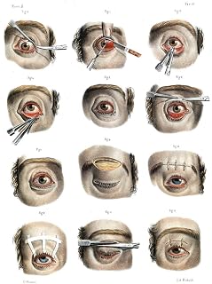 Corrective Eye Surgery for the Treatment of Blepharoptosis and Ectropion Composition Notebook: Wide Ruled Note-Taking Book (Old Medical Illustration Composition Notebooks)