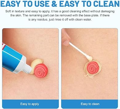 Ostomy Paste Ostomy Supplies, 2 oz Colostomy Skin Barrier Paste, Stomahesive Protective Skin Barrier Paste, Stoma Supplies, Preventing Ostomy Pouch Leakage