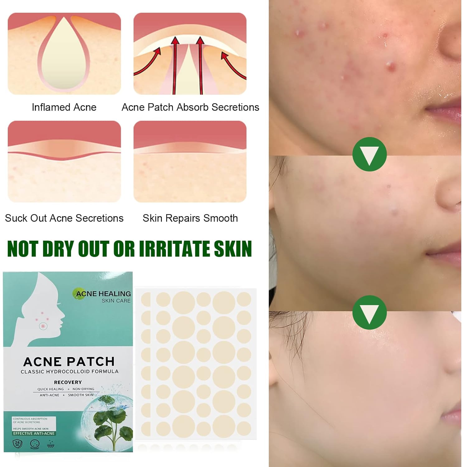 pimple patches for face+4 Pcs Blackhead Removal Tool mighty patch Hydrocolloid Acne Pimples