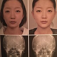健康・医学 facial bone contouring surgery Facial Bone Contouring Surgery: A Practical Guide