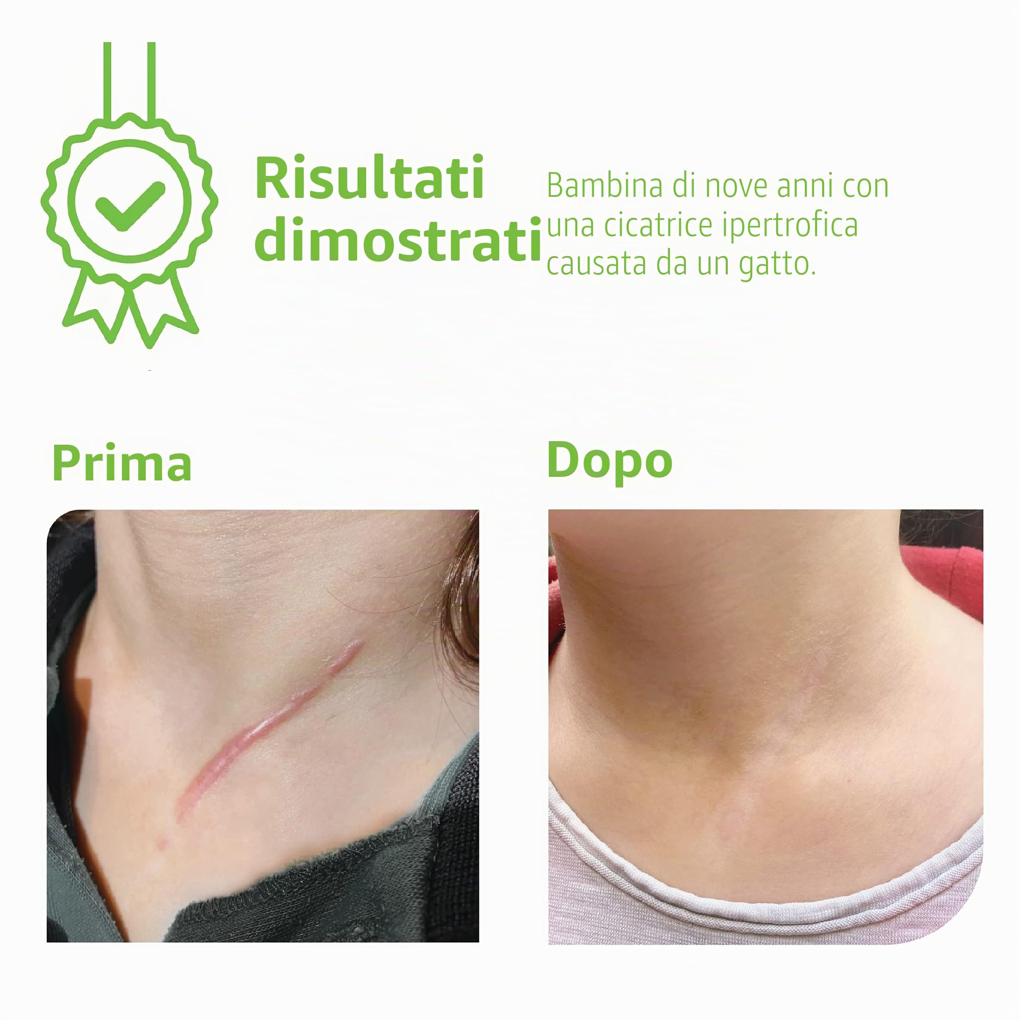 Skin feel - Riduce Tutti i Tipi di Cicatrici e Ustioni - Silicone Medico - 5 Piastre Sottili - Sana e Previene Cheloidi e Cicatrici Ipertrofiche (4 x 30cm)
