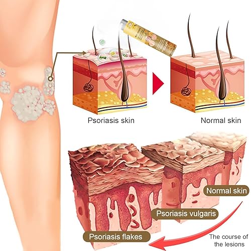 Miniatura 4 de Spray de tratamiento de veneno de abeja elimina manchas para hombres y mujeres, aerosol de decoloración de veneno de abeja, aerosol para la piel de