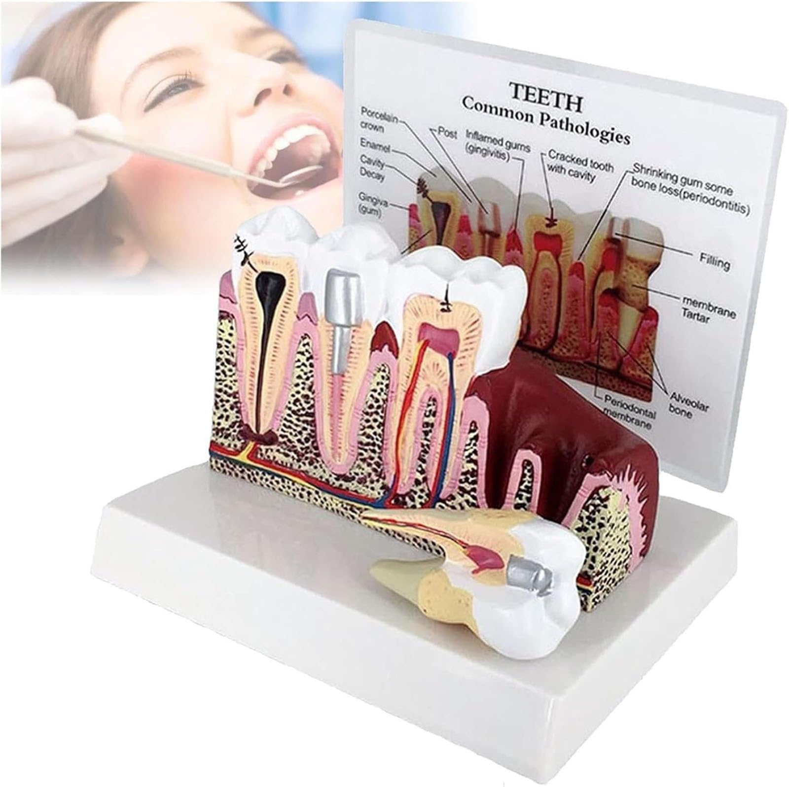 Tooth Model, Dental Caries Tooth Model,Teeth Cross-Section Model Gums Model Anatomy Teeth Model Detachable Education Dental Model for Students