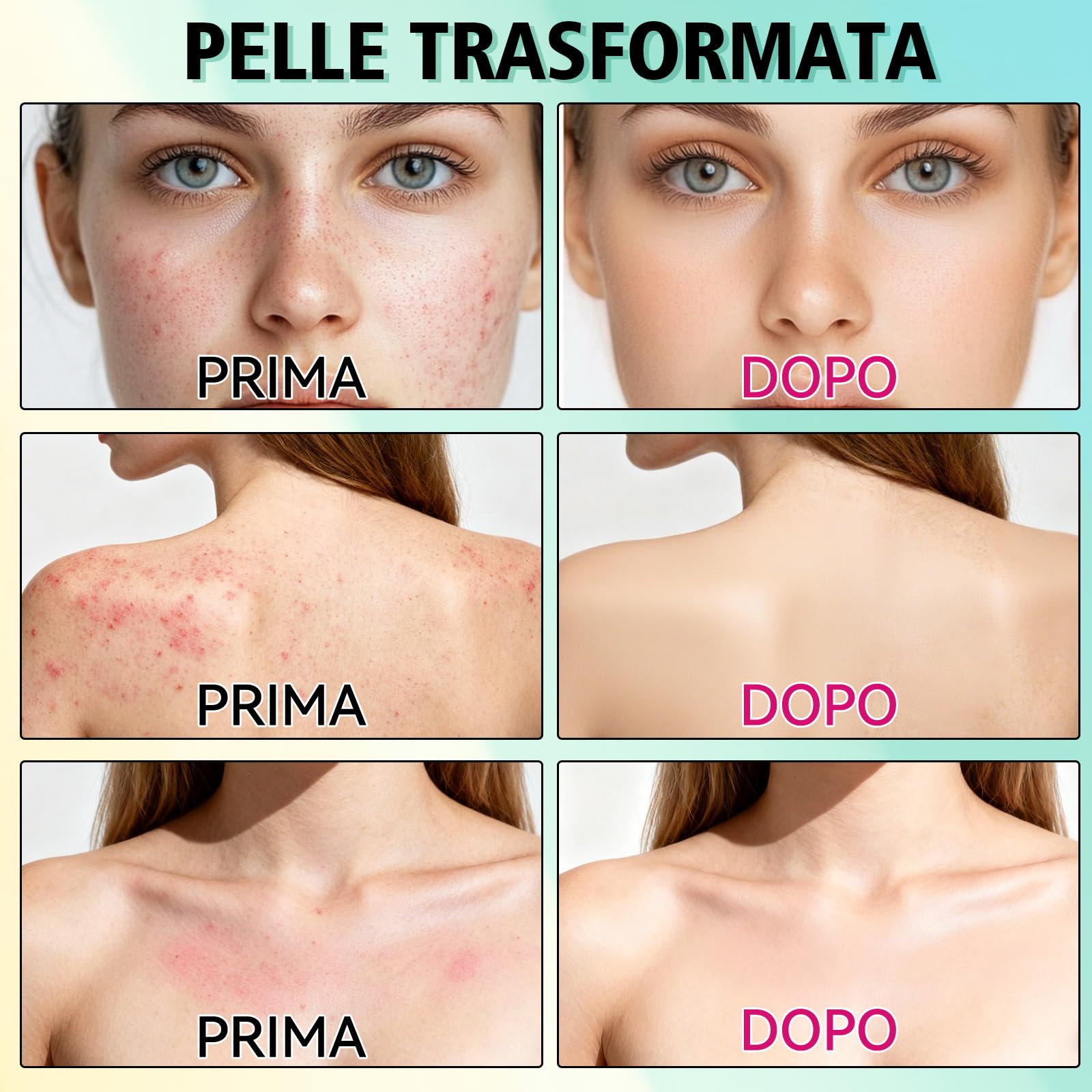 Crema Brufoli Viso, Crema Acne Potentissima, Cura per Brufoli e Imperfezioni, Riduce Subito Acne e Brufoli, Punti Neri e Rossori, Adatta a Tutti i Tipi di Pelle e Età,per la Pelle di Viso e Corpo