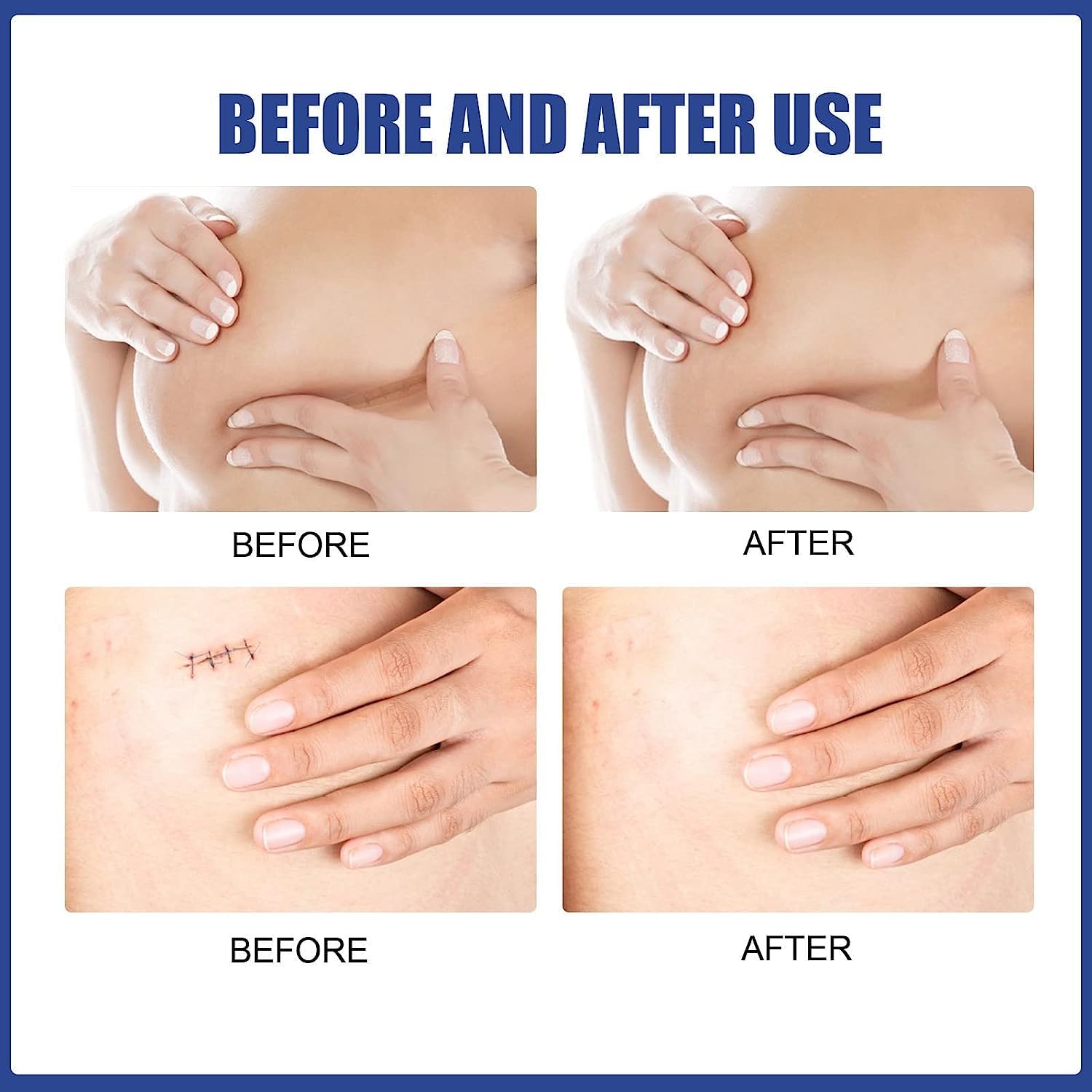 1/2/3Box Silicone Scar Sheets Silicone Scar Sheets For Breast 8 Pack Breast Reduction After For Scar Removal Sheets 4 Areola Soft Strips 4 Sheets (2Box)