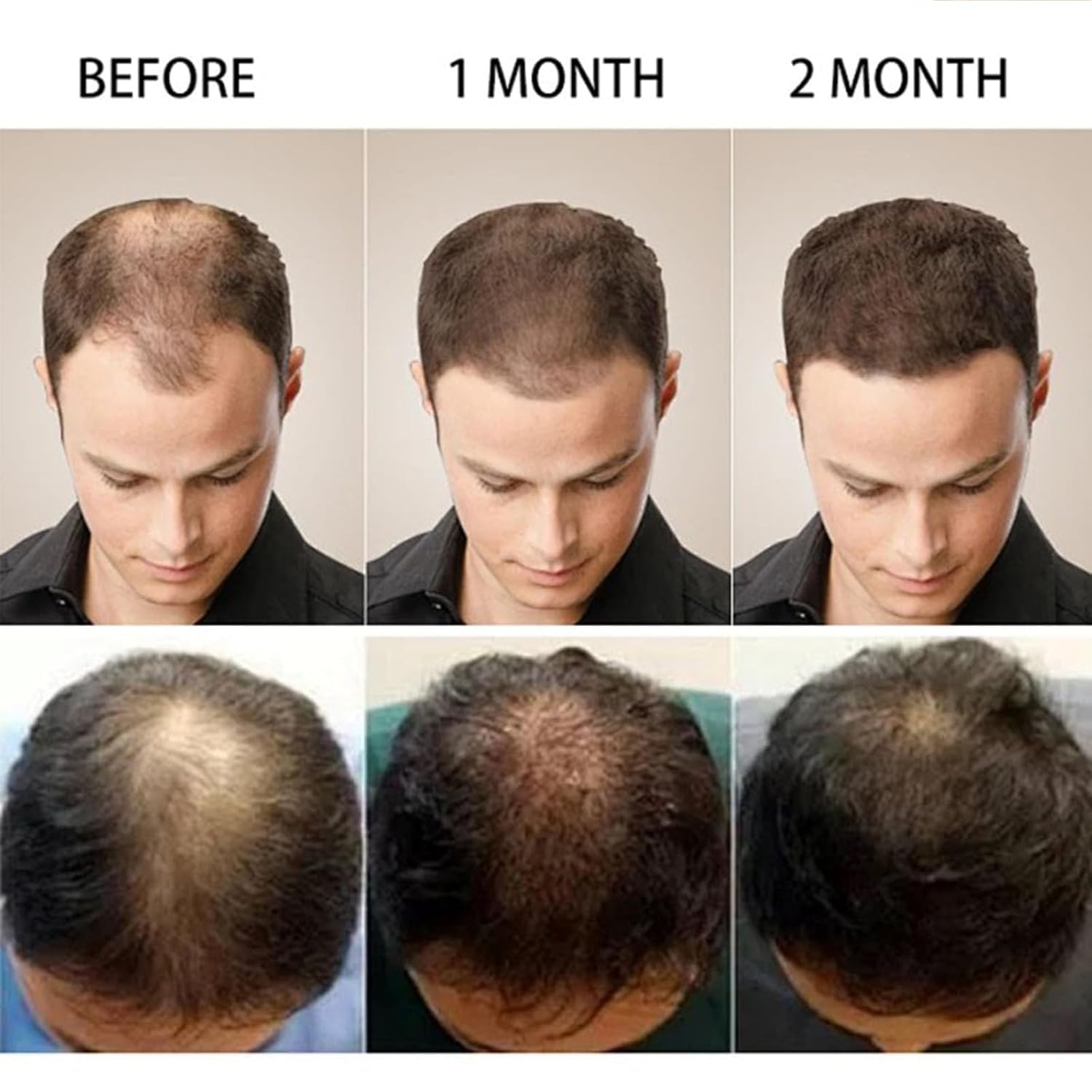 5% Minoxidil Hair Growth Scalp Massage Cream, Professional Hair Care Minoxidil, Anti Hair Loss Treatment with Rosemary Biotin for Men & Women, Fast Regrowth & Strengthens Hair Roots