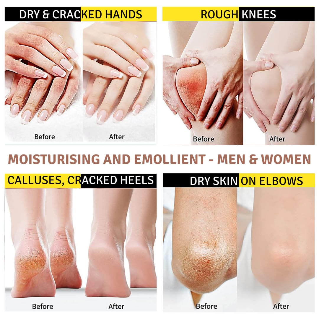 Crema Urea 20%, Eczemi, Cheratosi, Psoriasi, Eruzioni Cutanee, Riduce il Prurito, Sechezza, Pelle Secca e Screpolata, Calli, Duroni, Desquamazioni,- Cocos e Olio d'Oliva, 50g