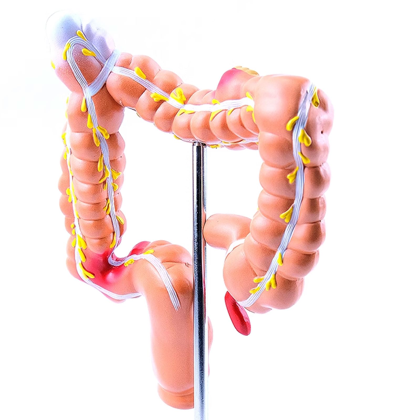 The Large Inestine Model Large Intestine Model With Diseases Anatomystuffcouk Intestinal