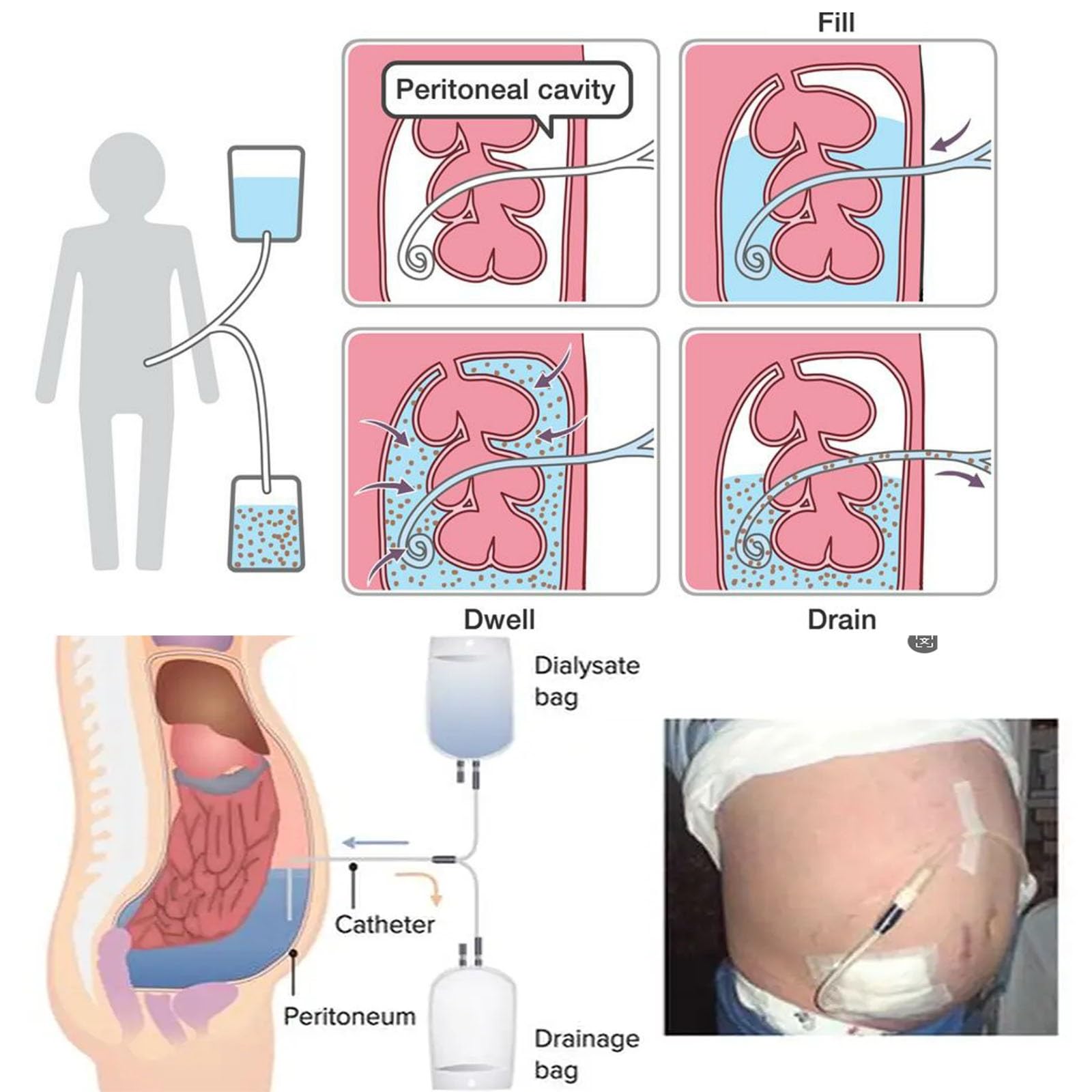 Modèle de dialyse péritonéale, mannequin de l'abdomen humain pour l'éducation médicale, démonstration et simulation avec design d'insertion de tube