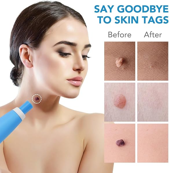 DermaSkin Pro - Adieu Les Acrochordons Améliore La Douceur De La Peau Indolore Et Facile À Enlever Pour Femme (Bleu 1 ensemble) - 5