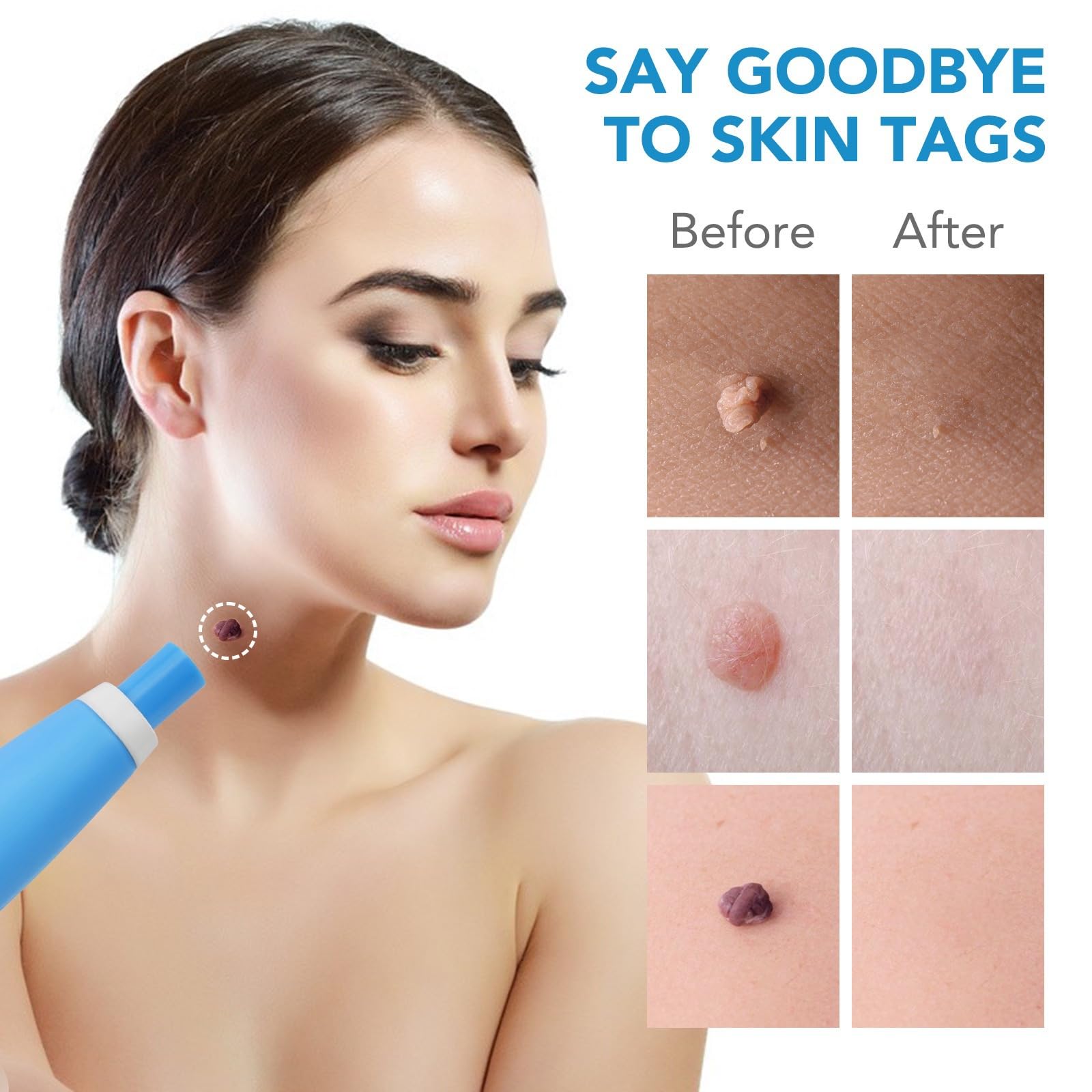 DermaSkin Pro - Adieu les acrochordons (1 Kit)