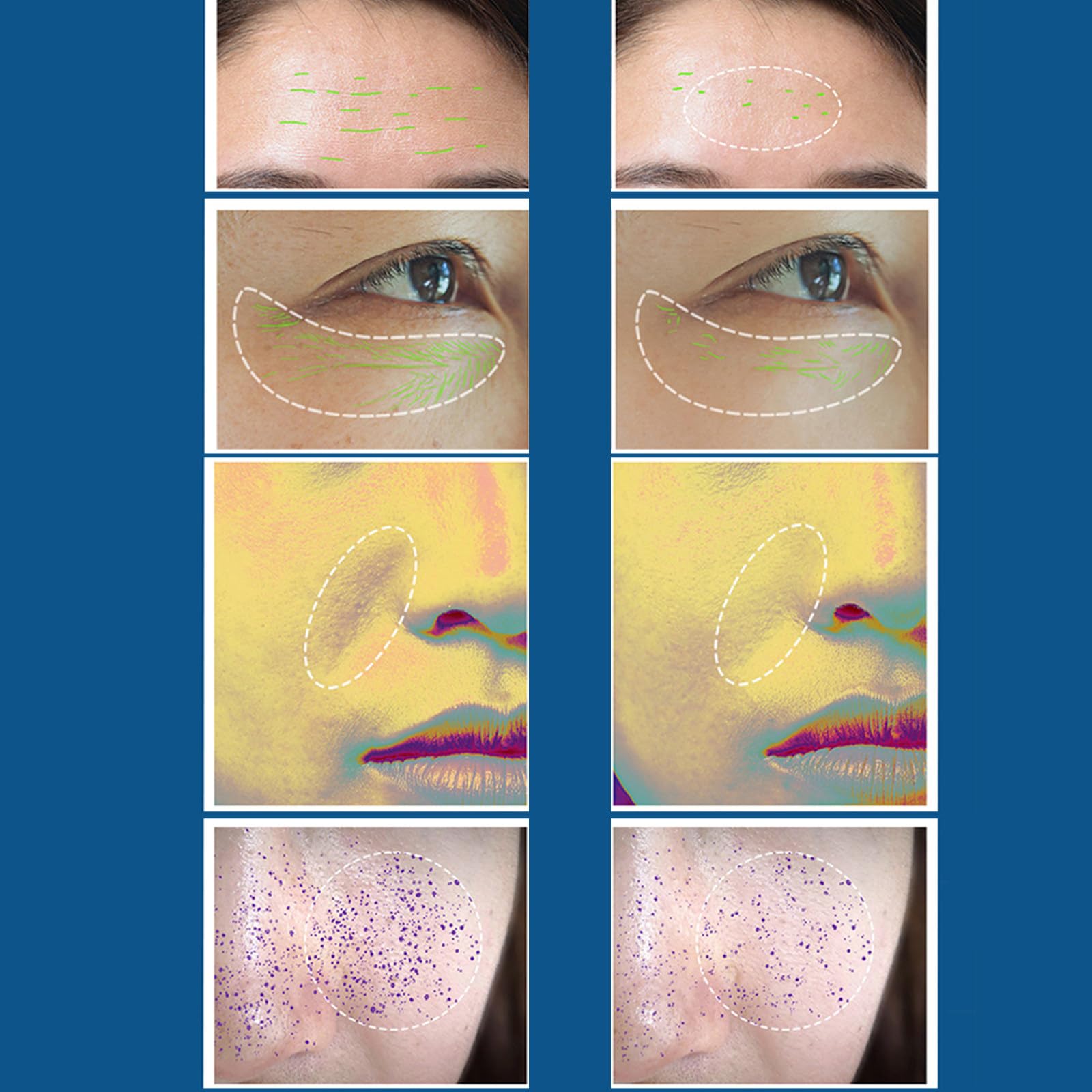 Profesjonalne urządzenie kosmetyczne RF do twarzy, aparat EMS z mikroprądami do odmładzania skóry, urządzenie do wprowadzania serum transdermalnego redukującego zmarszczki