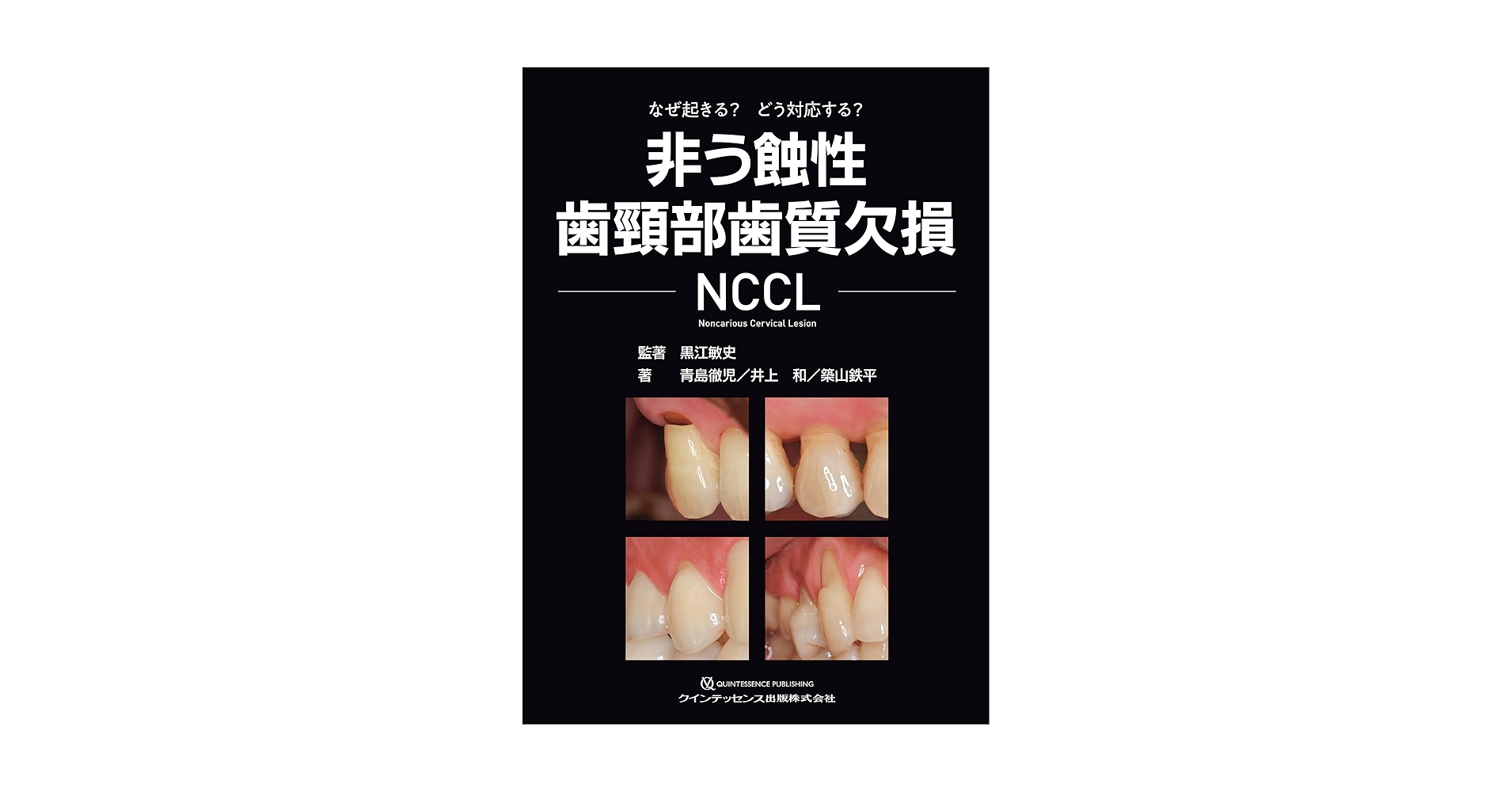 非う蝕性歯頸部歯質欠損NCCL※裁断済 非う蝕性歯頸部歯質欠損 NCCL