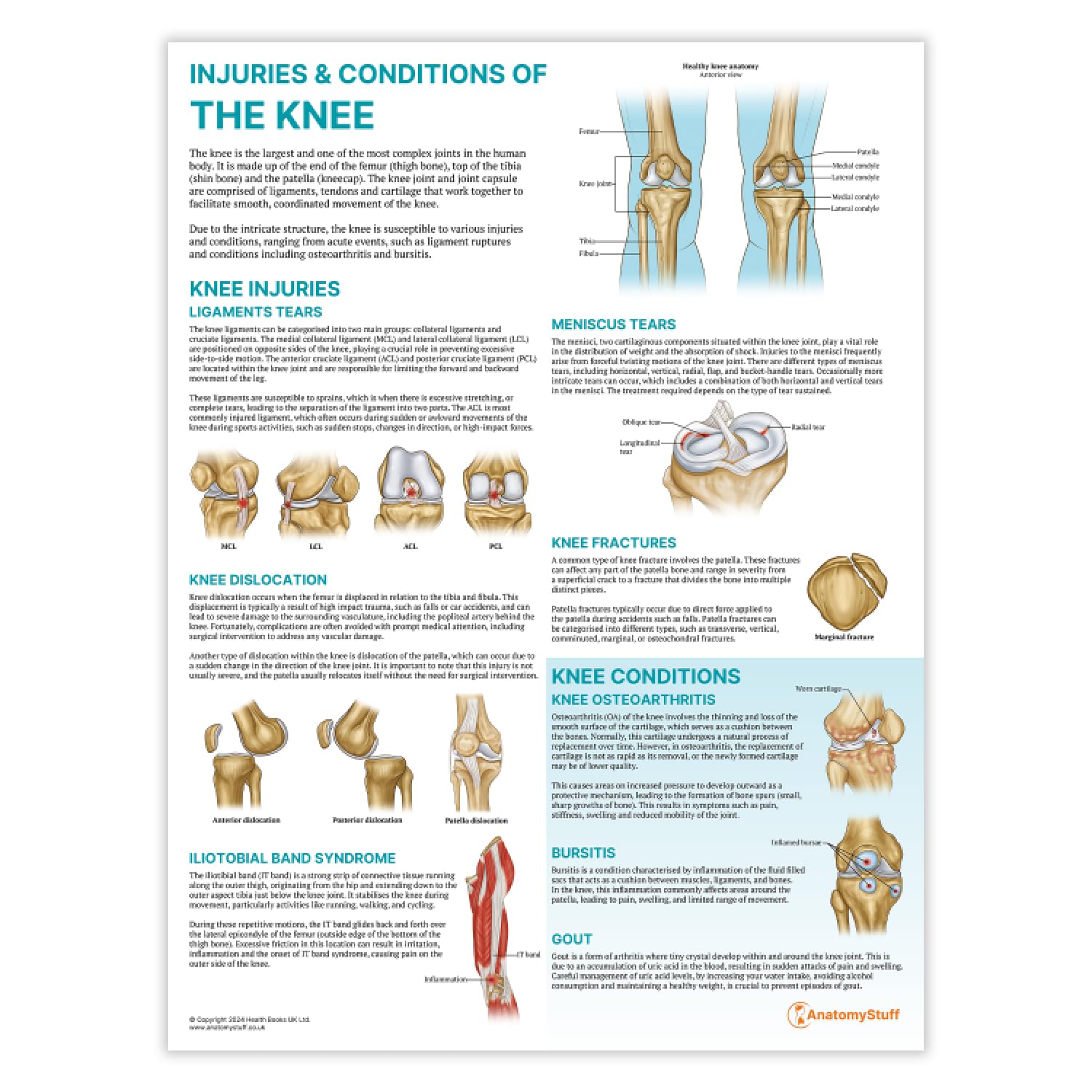 Anatomy Stuff Injuries and Conditions of the Knee Poster, 45x60 cm, 18x24 inches, Physio Diagram, Sports Medicine Wall Chart