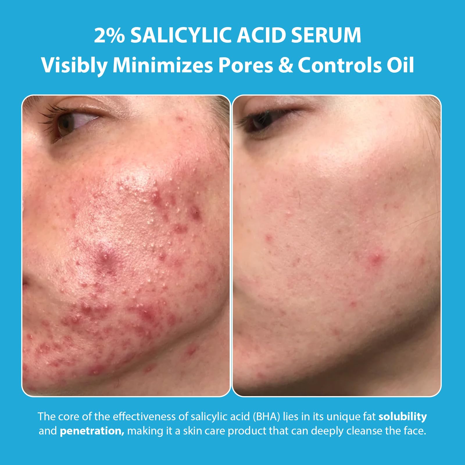AOPEIBOTO Salicylic Acid Serum 2%, Acne Treatment for Face Gentle Exfoliating Serum for Acne Pore Minimizing, Oil Controlling - Image 2