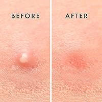 Vista 8 de Rael Parches para espinillas, invisibles y microcristales, parche hidrocoloide para espinillas para acné para cara, zit e imperfecciones, brotes