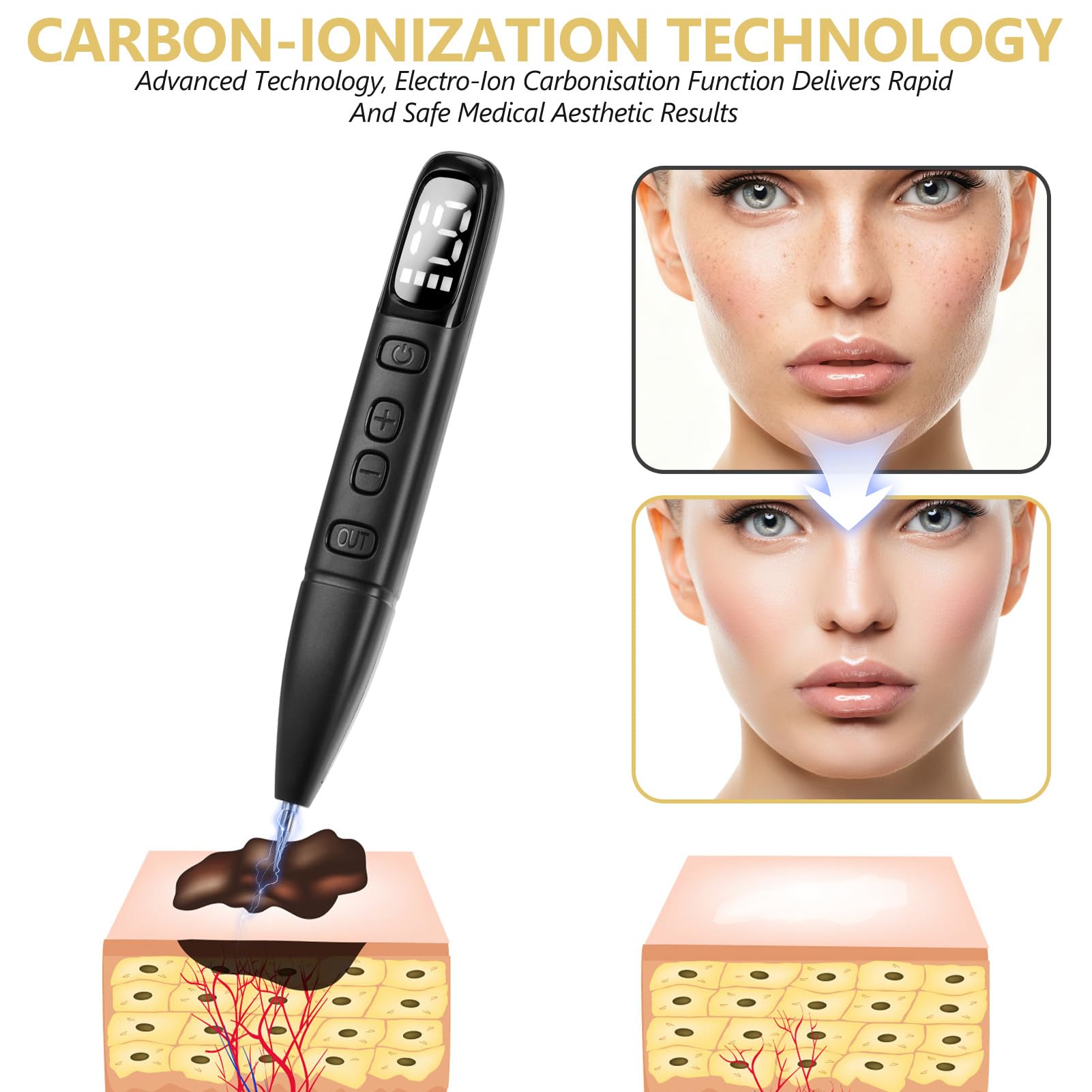 Sicura e Penna al Plasma, Rimuove Voglie Verruche Skin Tag Remover con 19 Livelli Regolabili e Luce LED, Strumento Dermatologico Ricaricabile Portatile per Nei, Verruche, Lentiggini, Macchie Scure