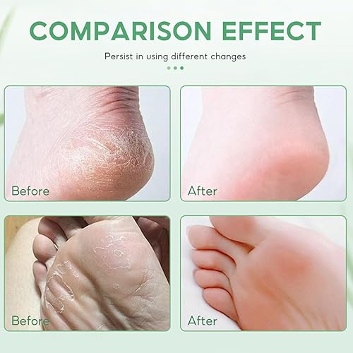 Miniatura 5 de Crema de pies para pies secos y agrietados, loción de menta para pies secos y agrietados, crema hidratante para talones secos y agrietados,