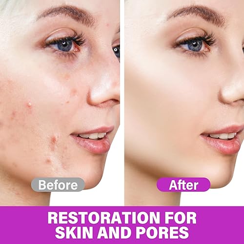 Miniatura 4 de Crema facial de ácido azelaico facial, 12% ácido azelaico suero y niacinamida, elimina eficazmente las manchas oscuras, alivia el enrojecimiento