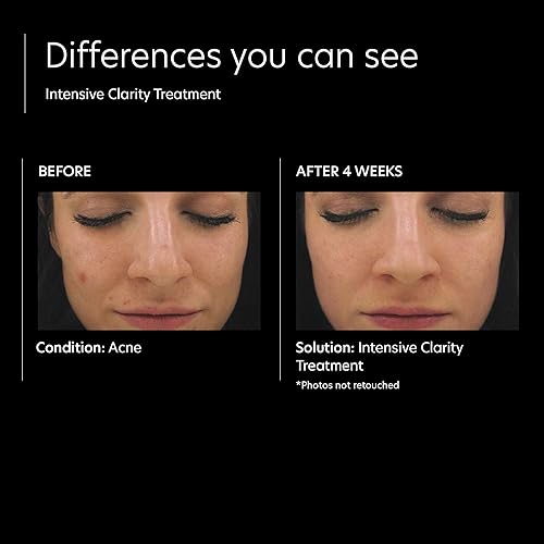 Miniatura 7 de PCA SKIN El juego de cuidado de la piel para el control del acné (kit incluye limpiador facial BPO, crema facial de niacinamida, gel de acné de