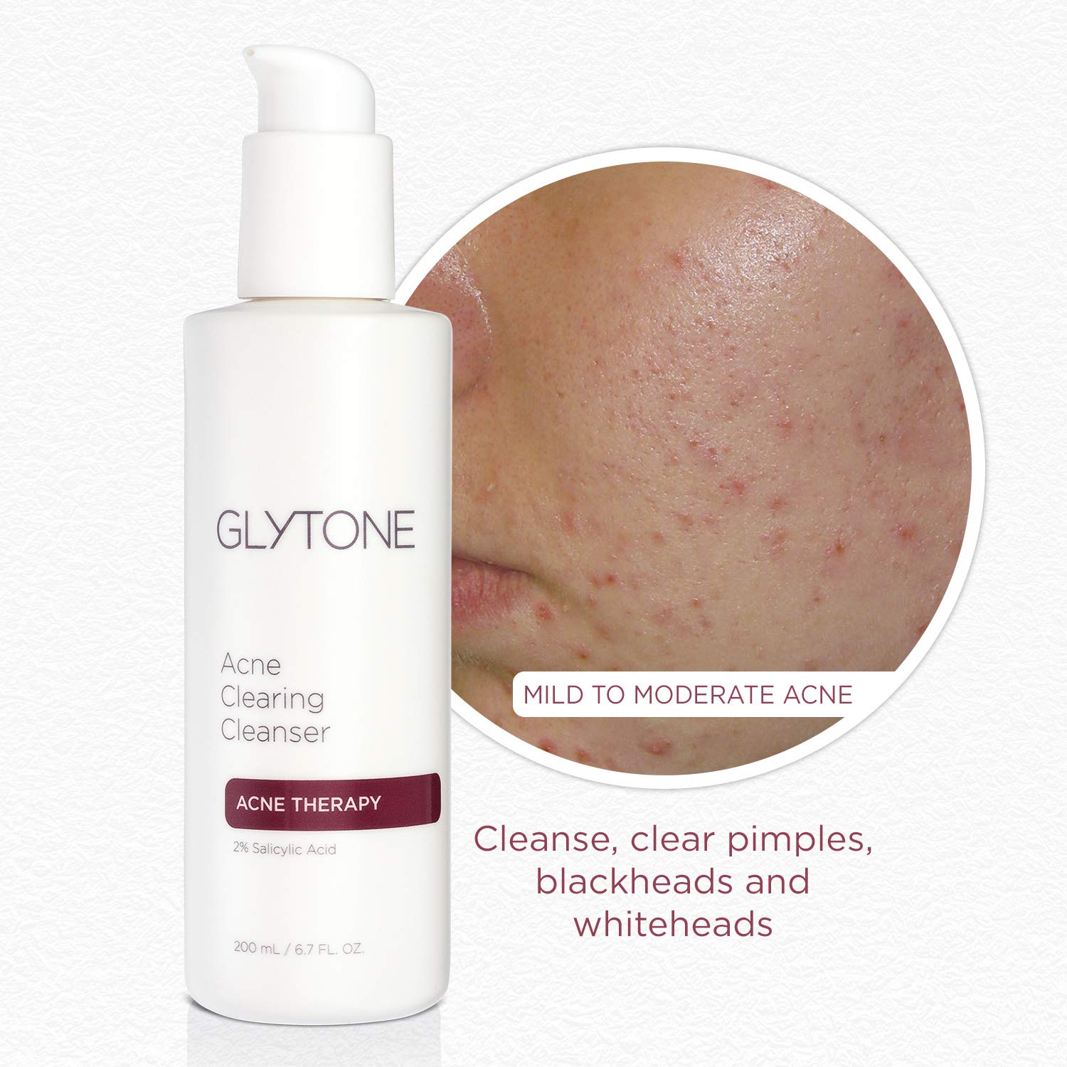 Glytone Acne Clearing Cleanser with 2% Salicylic Acid, Unscented