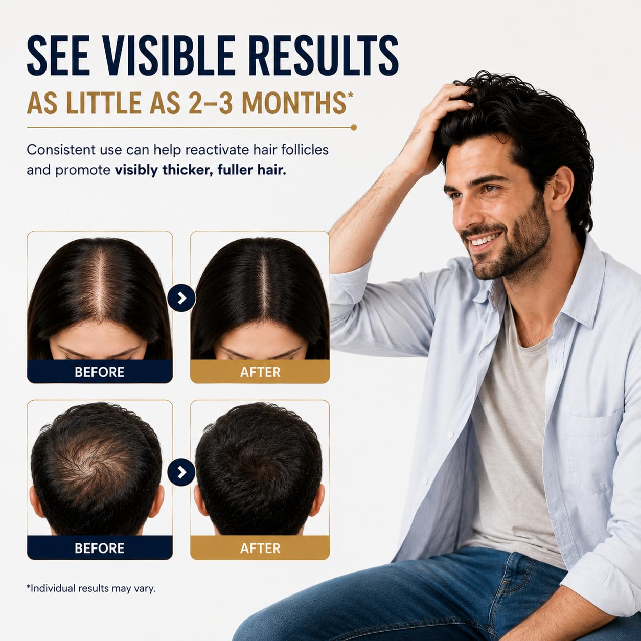 5% Minoxidil Hair & Beard Regrowth Serum for Men & Women, 3 x 2 fl oz