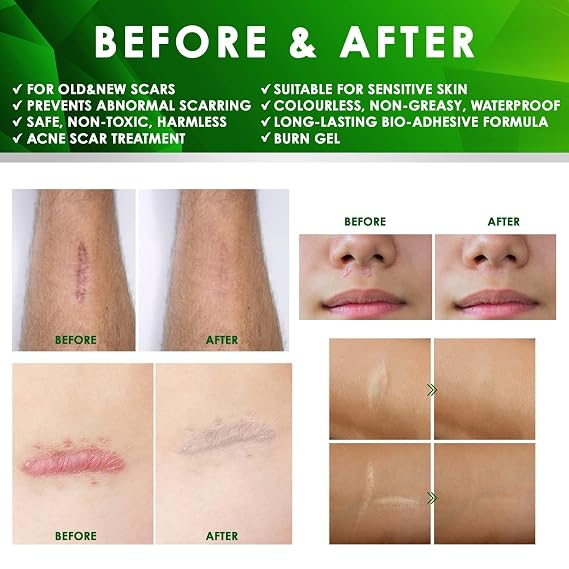 Tobcharm Advanced Keloid Bump Removal: Silicone Keloid Scar Removal Cream for Scars from Piercing, Surgical Marks, Acne, and Burns, Keloid Treatment for Ears, Face, and Body with Healing Formula 30g