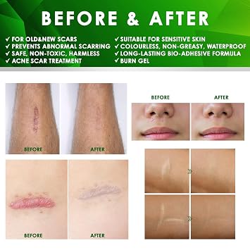 Tobcharm Advanced Keloid Bump Removal: Silicone Keloid Scar Removal Cream for Scars from Piercing, Surgical Marks, Acne, and Burns, Keloid Treatment for Ears, Face, and Body with Healing Formula 30g