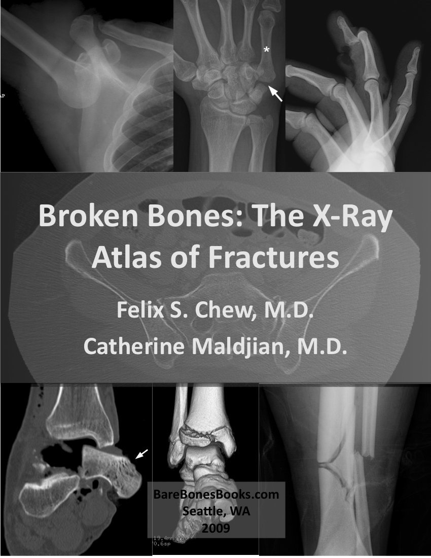 Broken Bones: The X-Ray Atlas of Fractures