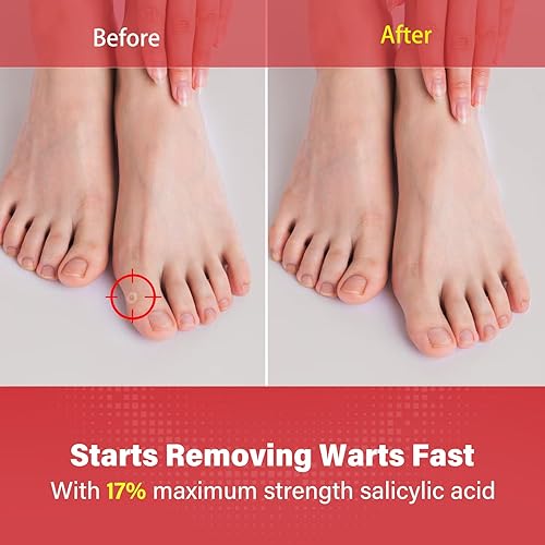 Miniatura 5 de Goodnites Eliminador de verrugas de acción rápida con ácido salicílico de máxima resistencia, elimina eficazmente las verrugas comunes y plantares,