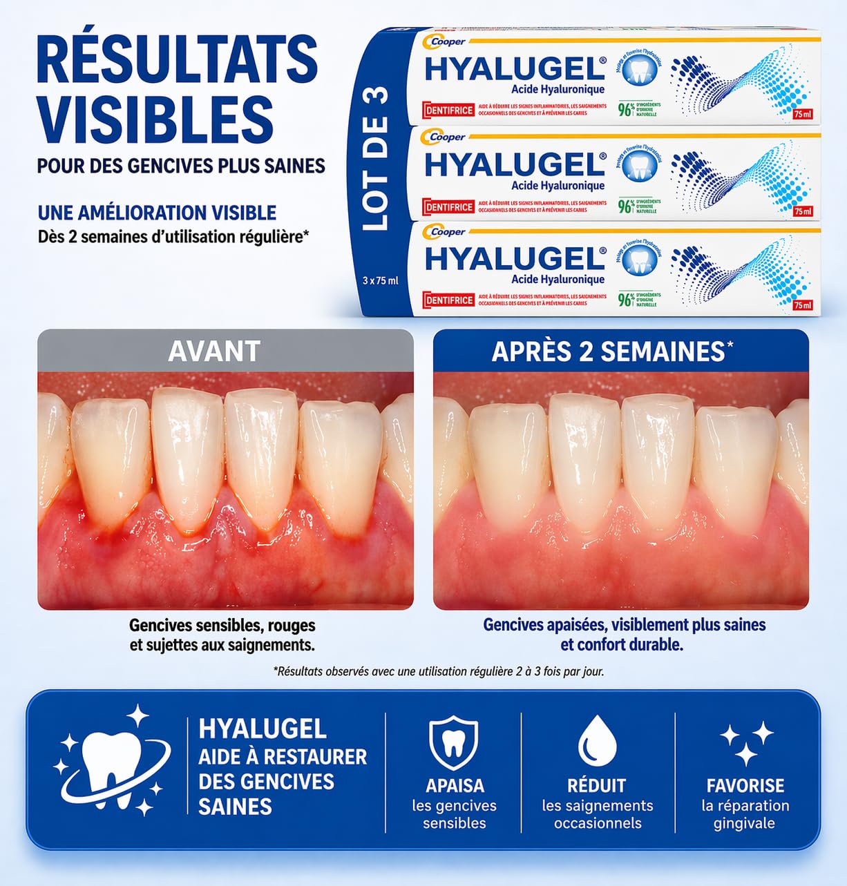 Dentifrice Acide Hyaluronique 75 ml – Lot de 3 – Soin Gencives Sensibles, Apaise & Réduit les Saignements – Protection Quotidienne Buccale – Formule Expert