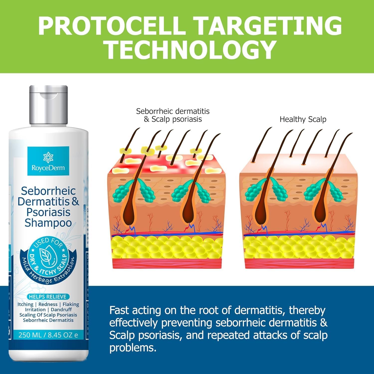 Roycederm Seborrheic Dermatitis & Psoriasis Scalp Treatment Kit – Shampoo + Cream for Dry Itchy Scalp, Dandruff, Folliculitis Relief, Anti-Itch & Soothing Care System