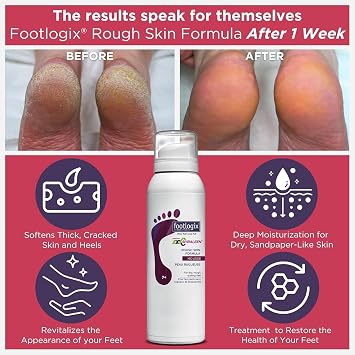 Footlogix Rough Skin Mousse Formula 125ml – Improves the Look of Dry, Flaky, Cracked Feet – For Rough Skin, Thick Heels, and Suitable for Diabetic Skin – Safe for All Skin Types
