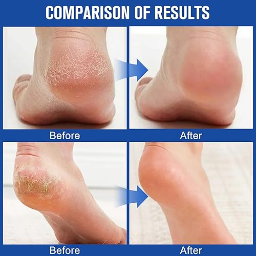Miniatura 5 de Holyarm 3 unidades de crema hidratante y antigrietas para pies, crema de urea de máxima fuerza para pies, loción de pies para talones, manos secas y