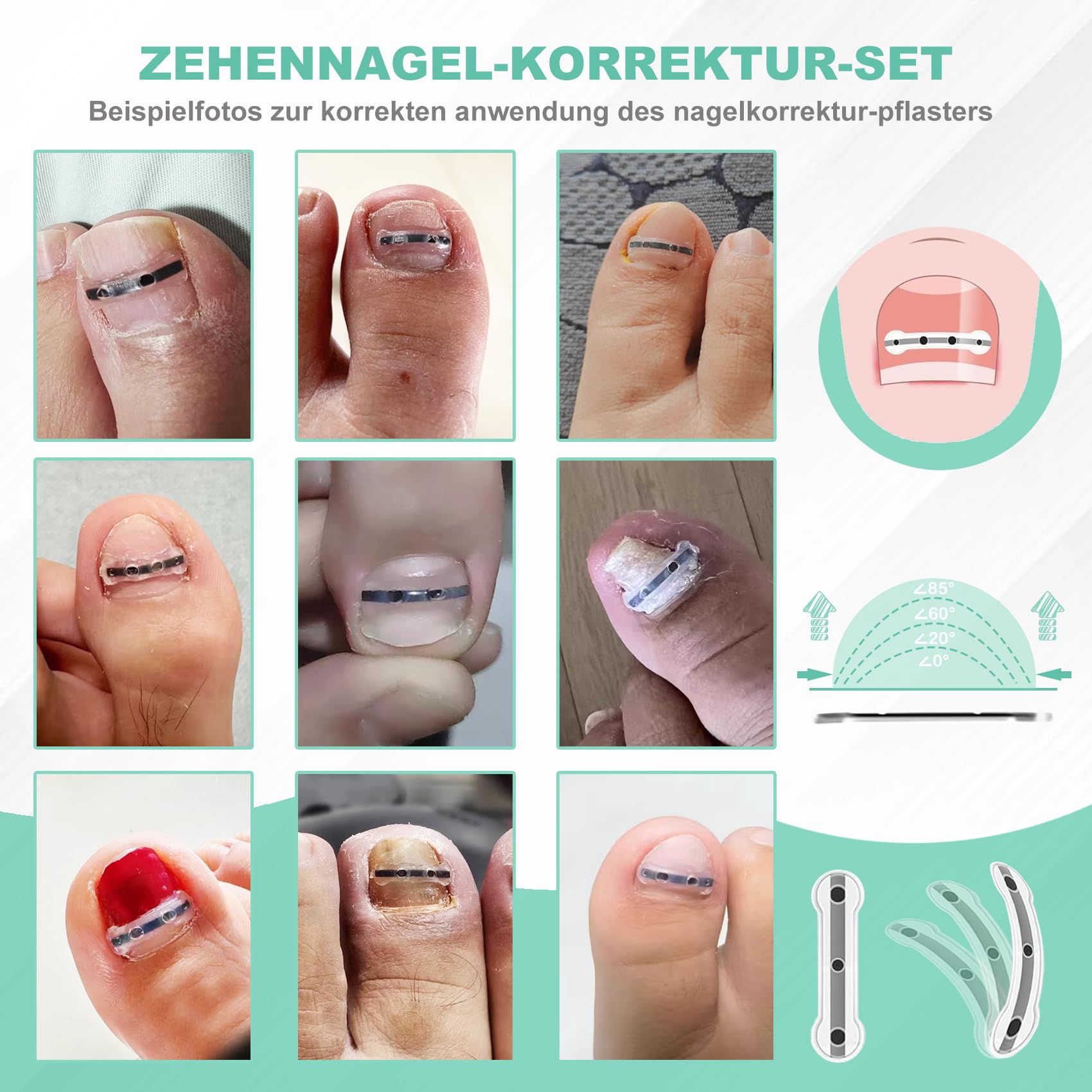 Eingewachsene Zehennägel Set Zehennagel Korrektur Patch 9pcs Nagelspange Fußnägel Zehennagelheber Werkzeugset für Paronychie Zehennagel Eingewachsen Reparatur, 0.59/0.67/0.79in