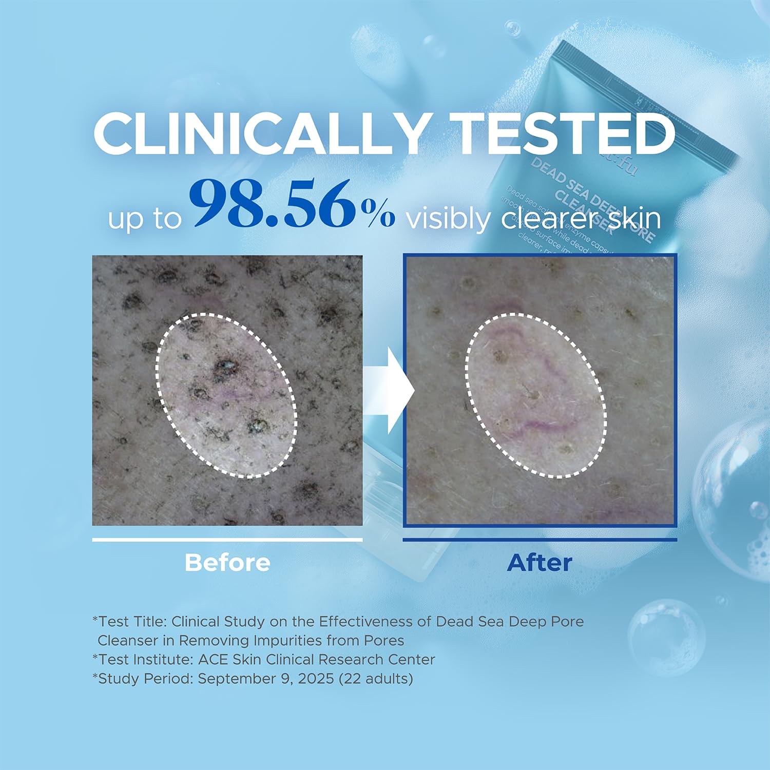 Deep Pore 2-in-1 Exfoliating Cleanser | Korean Hydrating Face Cleanser | Fungal & Hormonal Acne Support | Enzyme & Dead Sea Mud Formula (4.23 fl. oz) - Image 3