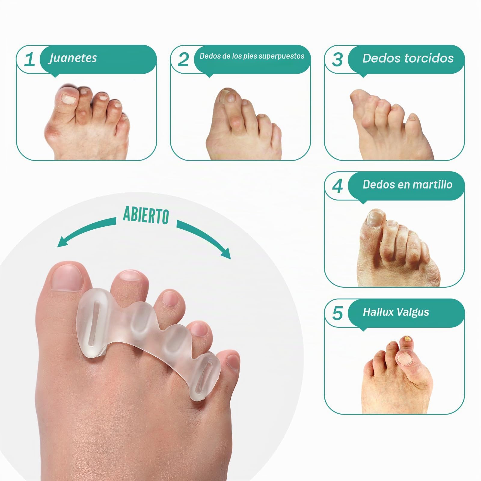 Welnove Separadores de Dedos para Corregir Juanetes - Separadores de Dedos para Mujeres y Hombres, Alivio del Dolor, Alineación de Pies, Enderezadores Ajustables (2 Pares con Caja de Regalo)